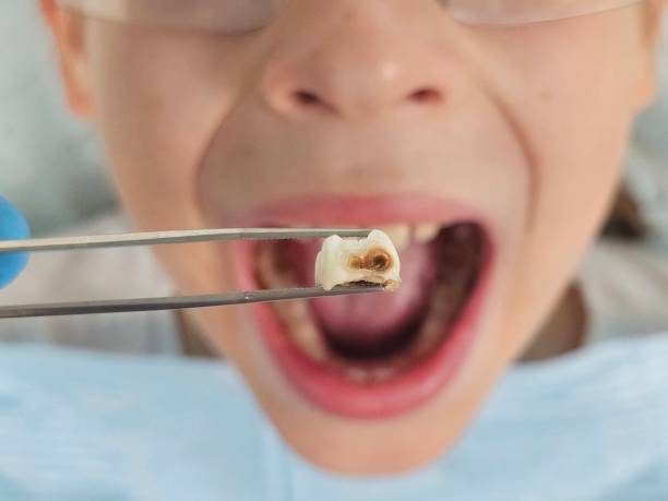 Best Emergency Tooth Extraction in North Enid, OK